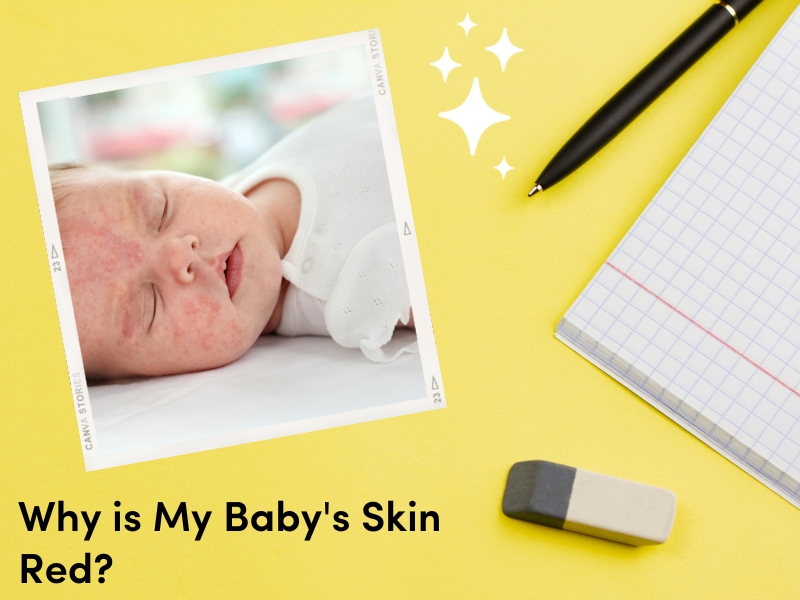 Why is My Baby's Skin Red? La Petite Creme